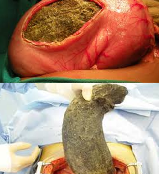 Trichobezoar Removal