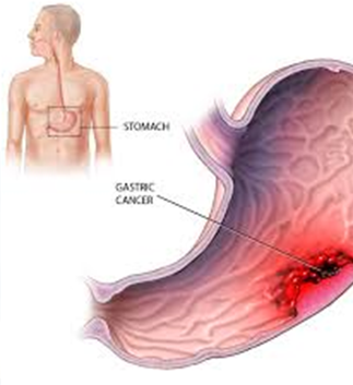 Stomach Cancer