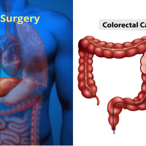 Colorectal Cancer: A Comprehensive GI Surgery Guide