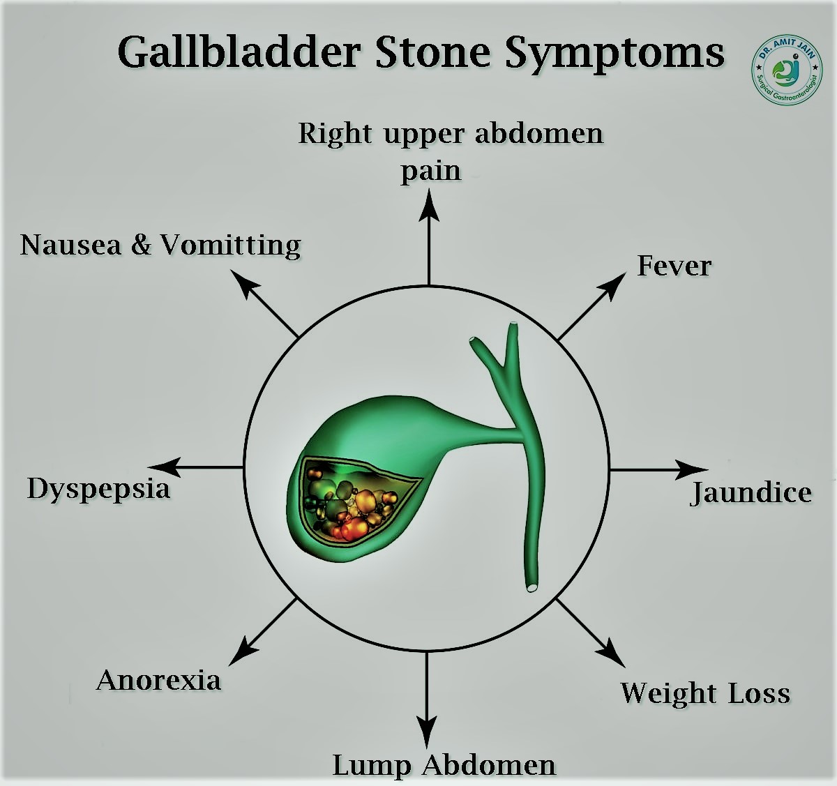 Are Gallstones or Gallbladder Stone preventable and best treatment option